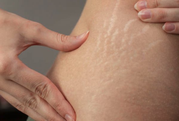 Les gaines ventre plat peuvent-elles aider à la réduction de la cellulite ?